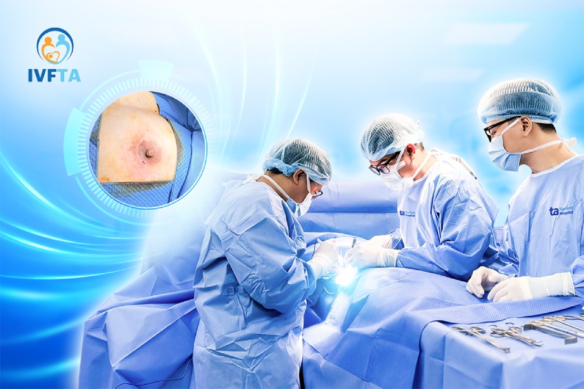 Ca phẫu thuật cắt bỏ mô tuyến vú được thực hiện bởi bác sĩ Huy và bác sĩ Danh tại IVF Tâm Anh Quận 8