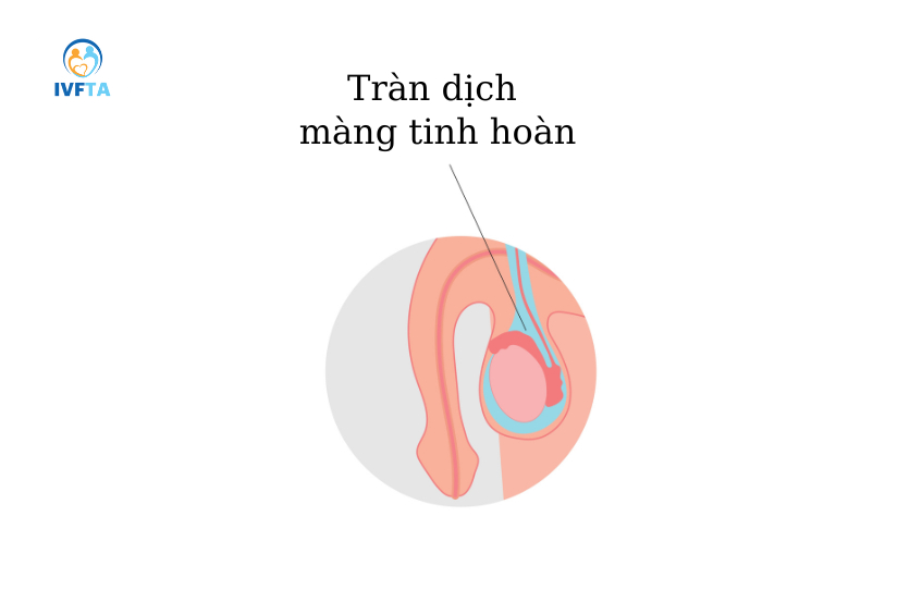 Hình ảnh minh họa tình trạng tràn dịch màng tinh hoàn