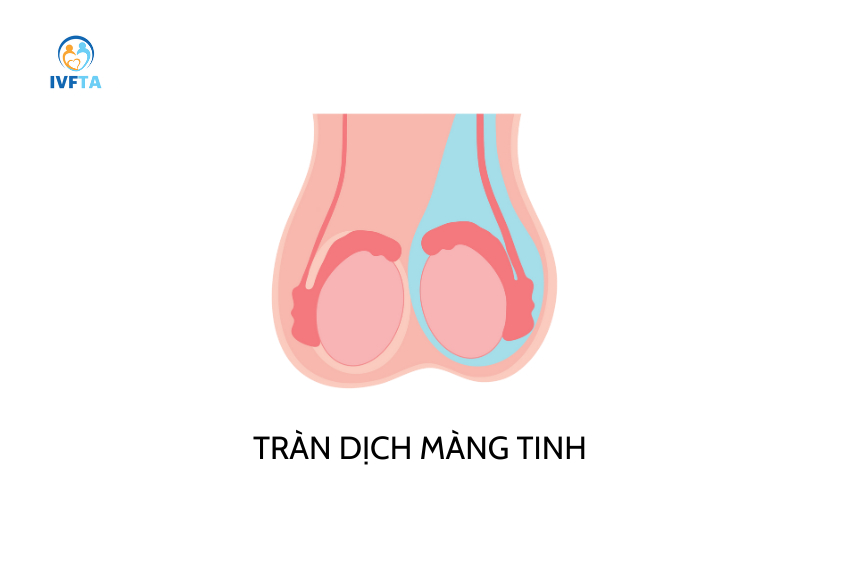 Hình ảnh minh họa tình trạng tràn dịch màng tinh