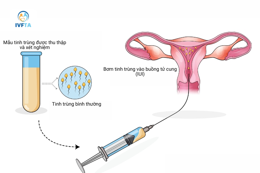 Minh họa phương pháp bơm tinh trùng vào buồng tử cung (IUI)