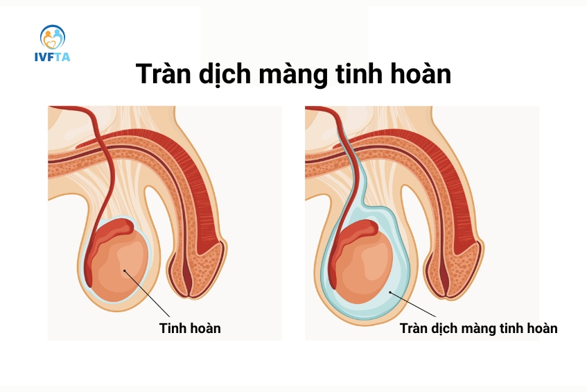 Phẫu thuật được chỉ định cho trường hợp khối dịch to tại tinh hoàn, gây ra triệu chứng khó chịu