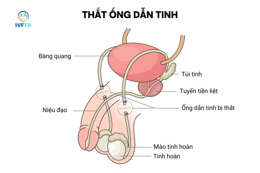 Phẫu thuật triệt sản làm “cắt đứt” con đường di chuyển của tinh trùng, loại bỏ khả năng thụ thai ở nam giới