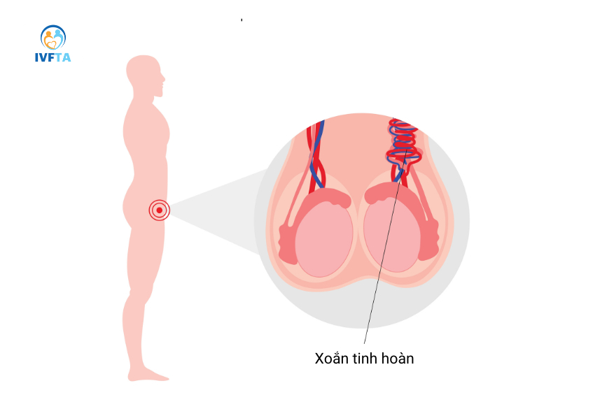 Tinh hoàn bên dài bên ngắn do xoắn tinh hoàn cần cấp cứu khẩn cấp để bảo tồn mô tinh hoàn