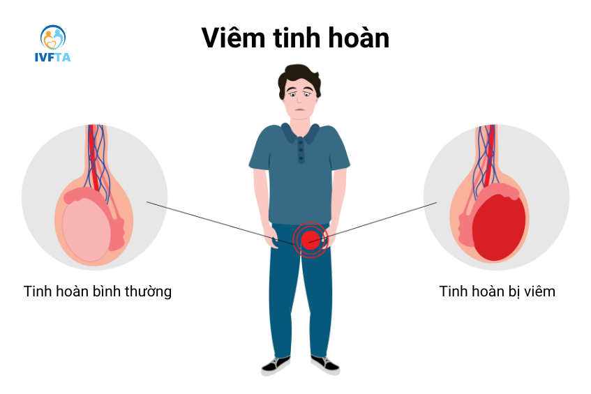 Tinh hoàn bị viêm nhiễm nếu không được điều trị kịp thời có thể gây teo tinh hoàn