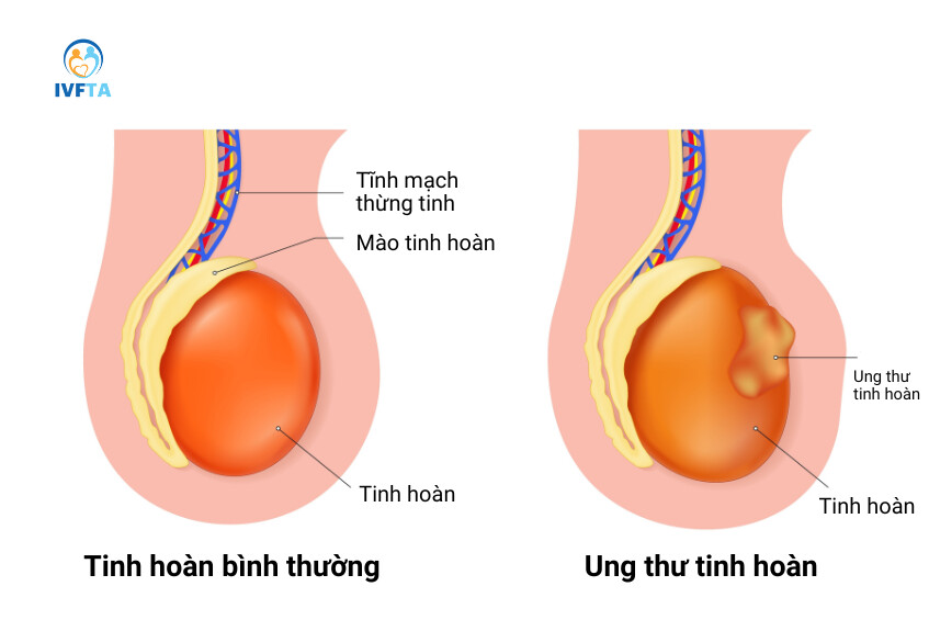 Ung thư tinh hoàn rất hiếm gặp nhưng có tiên lượng điều trị tốt nếu phát hiện sớm