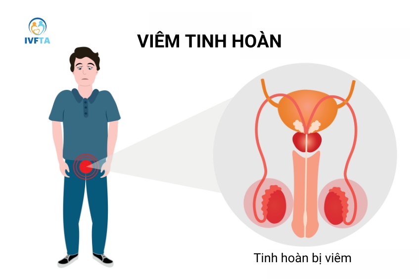 Viêm tinh hoàn là nguyên nhân phổ biến gây teo nhỏ tinh hoàn ở nam giới