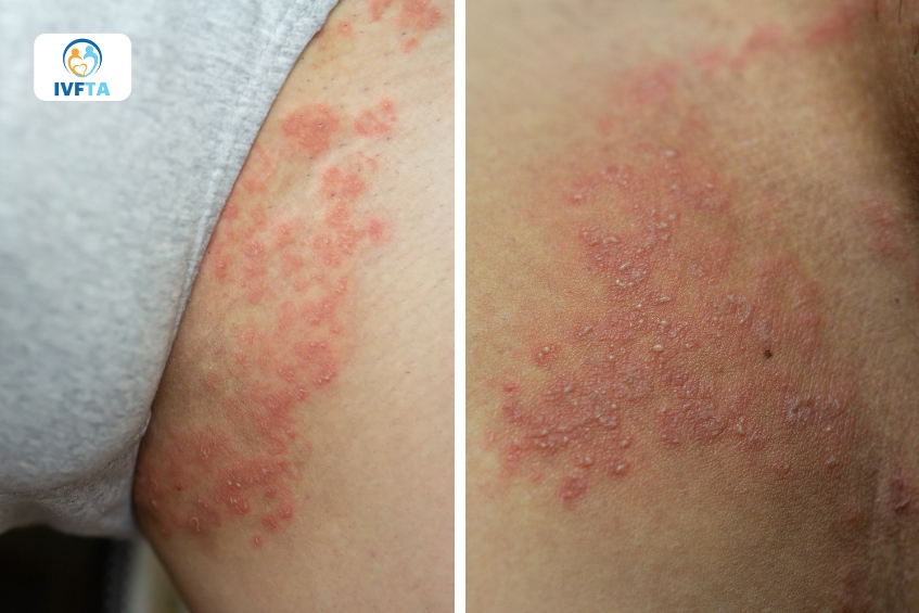 Hình ảnh nấm da bìu