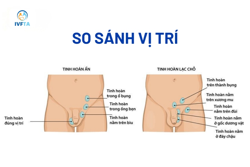 Hình ảnh so sánh các vị trí bất thường của tinh hoàn ẩn và tinh hoàn lạc chỗ Hình ảnh so sánh các vị trí bất thường của tinh hoàn ẩn và tinh hoàn lạc chỗ