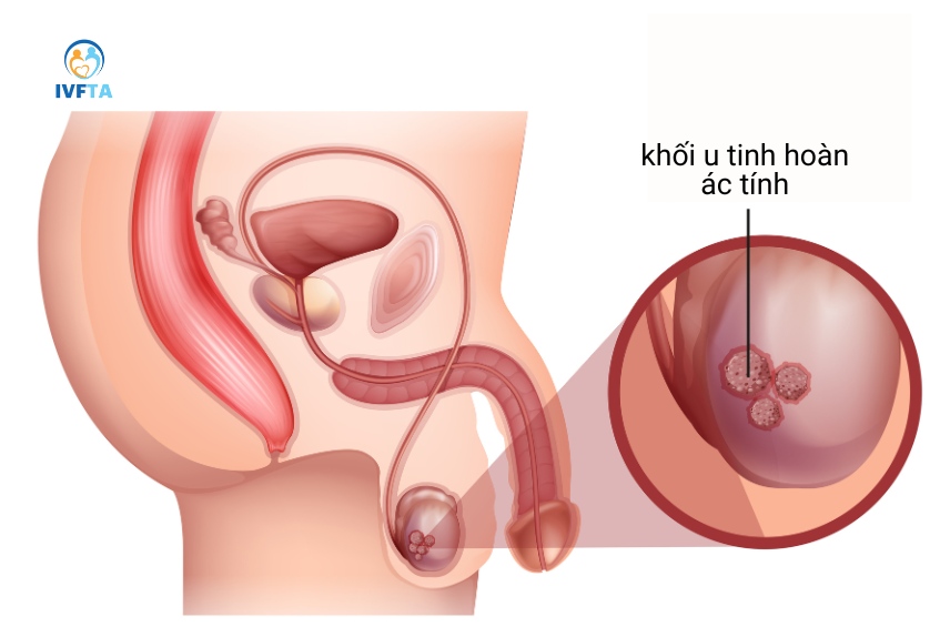 vôi hóa tinh hoàn là sự xuất hiện các nốt canxi nhỏ ở một hoặc hai bên tinh hoàn, thường lành tính