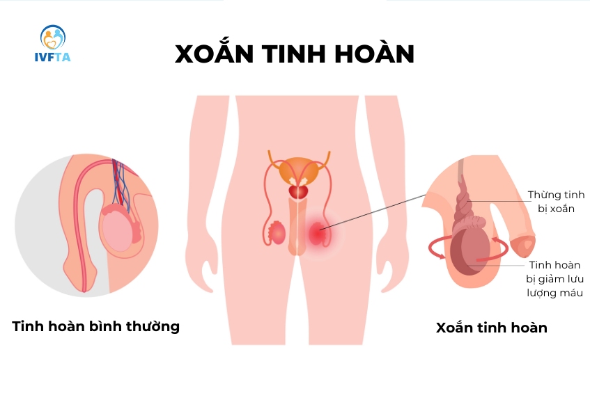 Xoắn tinh hoàn là tình trạng cấp cứu khẩn cấp với biểu hiện tinh hoàn sưng to kèm đau đớn dữ dội Xoắn tinh hoàn là tình trạng cấp cứu khẩn cấp với biểu hiện tinh hoàn sưng to kèm đau đớn dữ dội