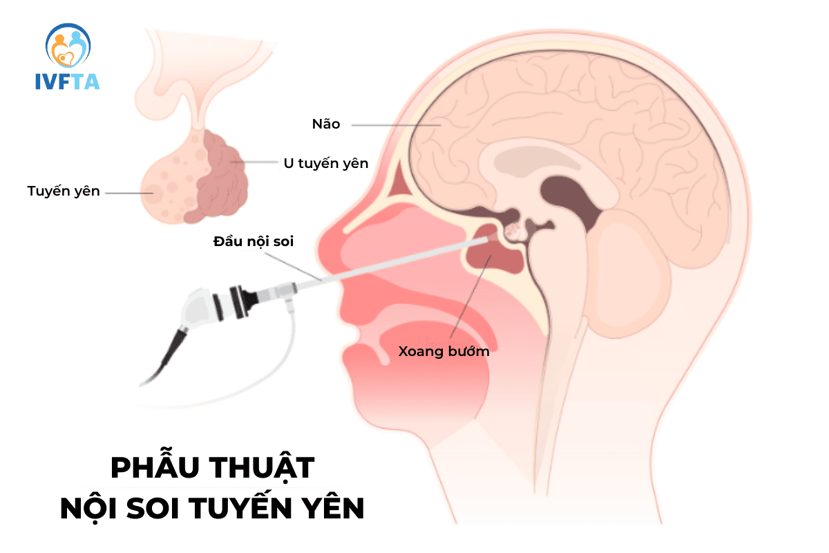 phẫu thuật nội soi điều trị u tuyến yên phẫu thuật nội soi điều trị u tuyến yên