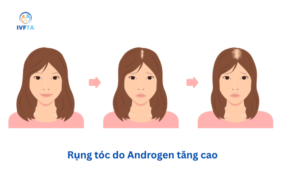 androgen tăng cao gây đa nang buồng trứng