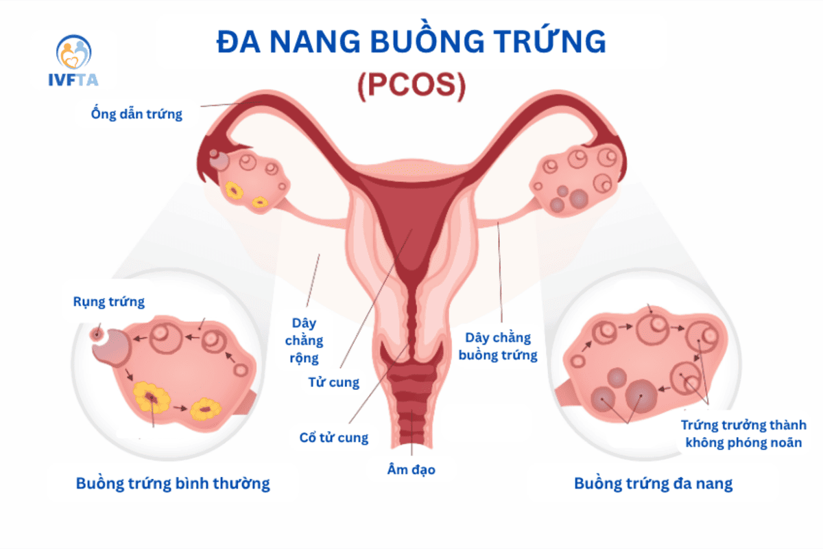đa nang buồng trứng 2 bên (bilateral pcos)