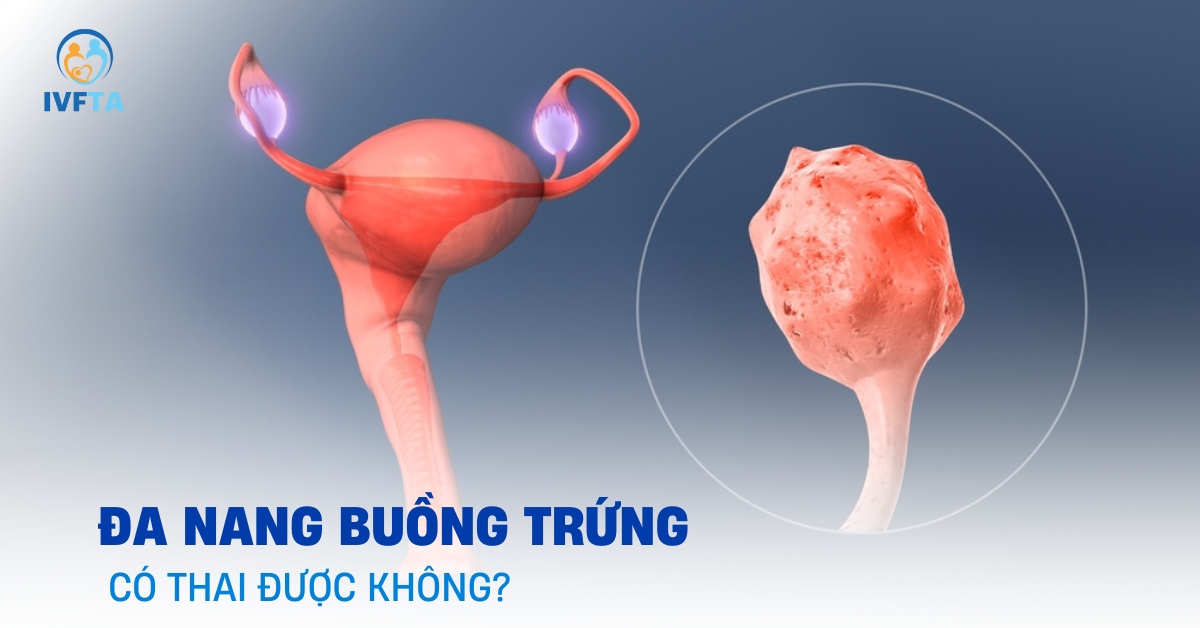 đa nang buồng trứng có thai được không