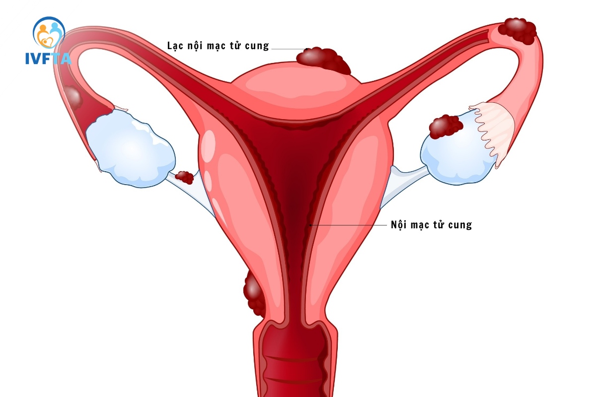 lạc nội mạc tử cung có thể gây vô sinh