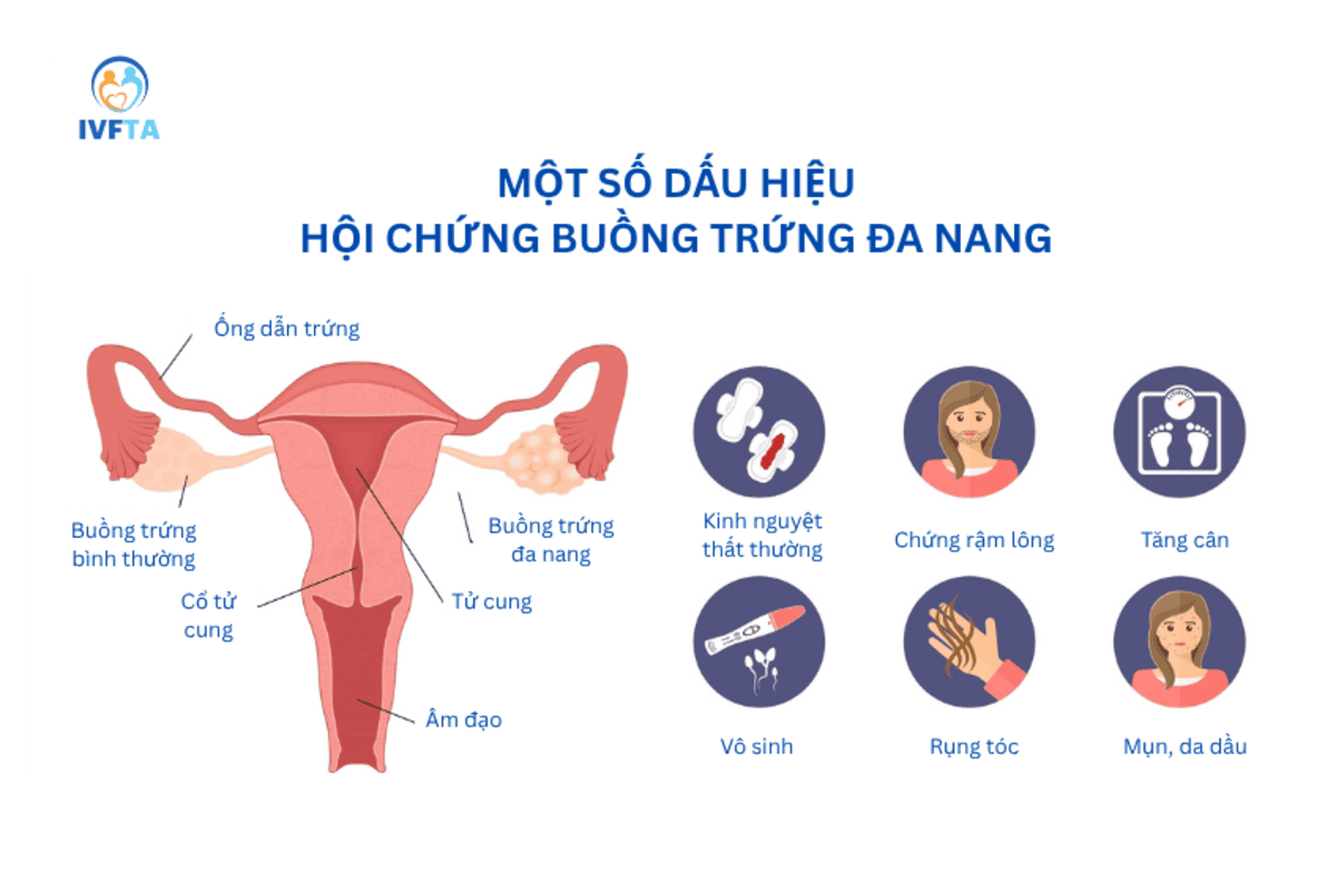 một số dấu hiệu buồng trứng đa nang 2 bên