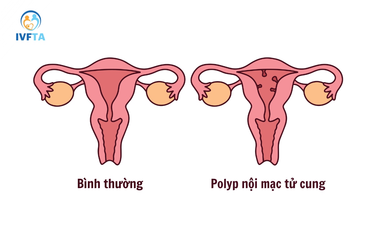 bệnh lý tại buồng tử cung khiến phôi không bám vào tử cung bệnh lý tại buồng tử cung khiến phôi không bám vào tử cung
